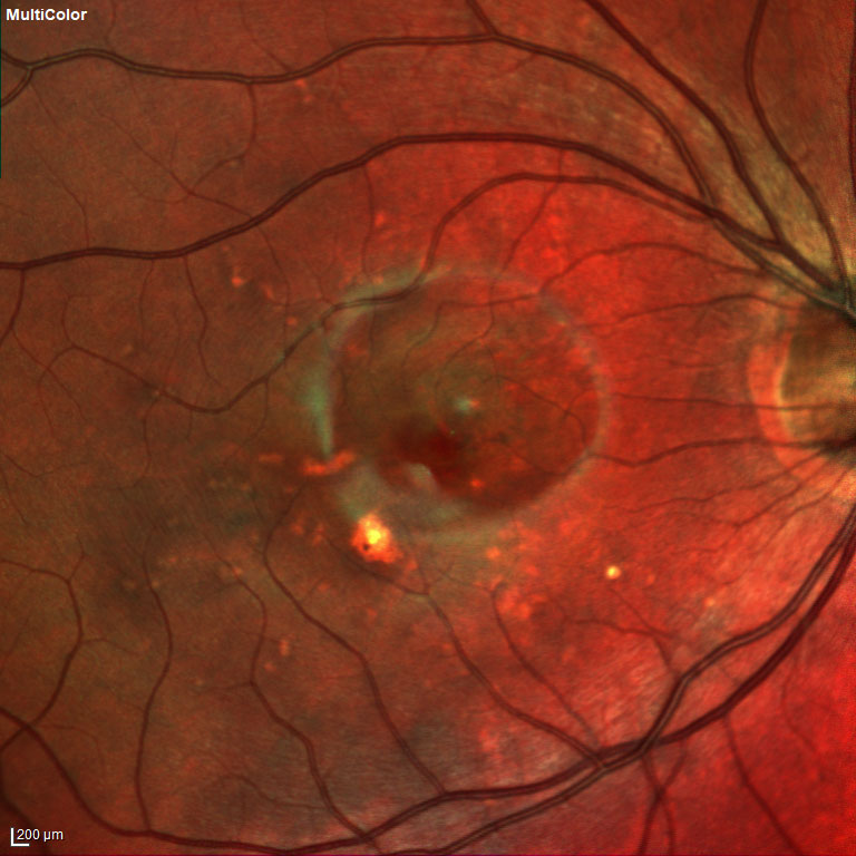 multicolor görüntüsü punktat iç koroidopati