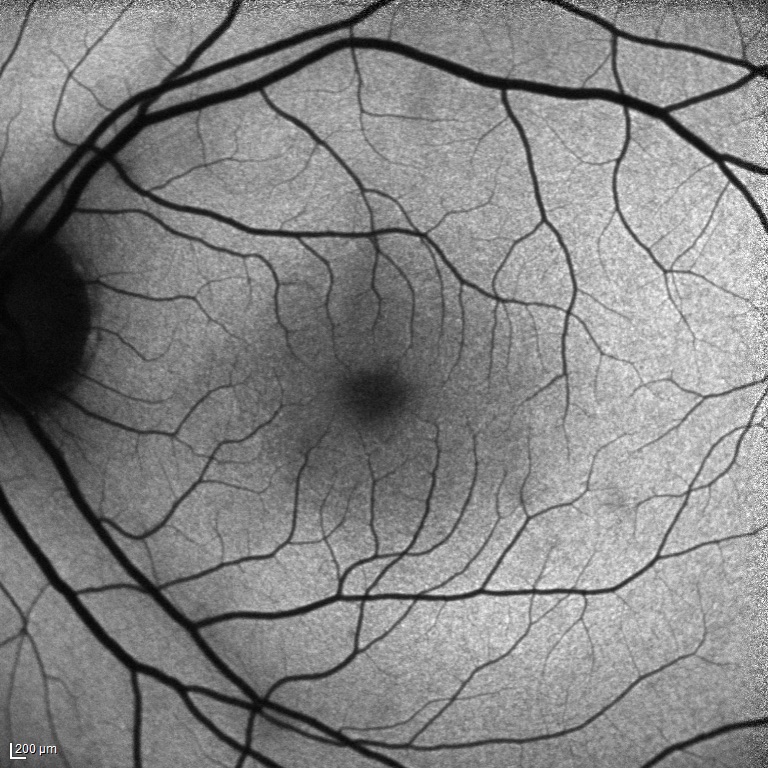 fundus otofloresans normal