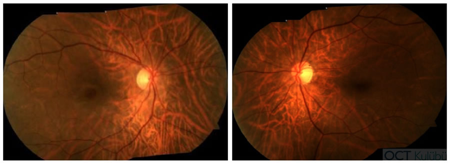 Santral Retinal Arter Tıkanıklığı Sekeli