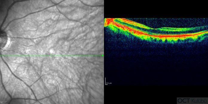 1 Santral Retinal Arter Tikanikligi Sekeli Oct Kulubu