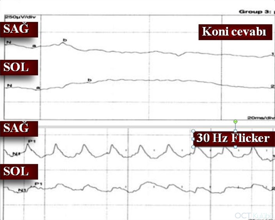 Santral Retinal Arter Tıkanıklığı Sekeli elektrofizyoloji