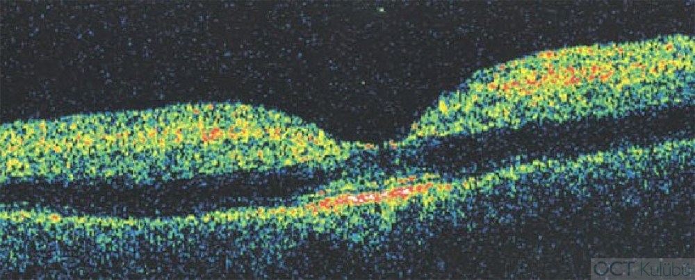 Santral Retinal Arter Tıkanıklığı OCT