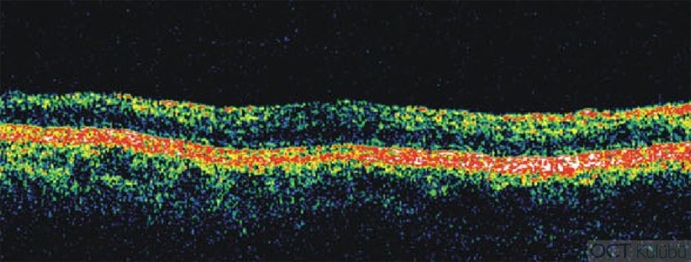 Santral Retinal Arter Tıkanıklığı OCT