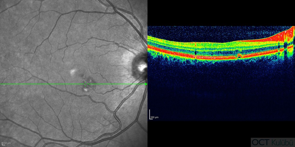 Pakikoroid Pigment Epitelyopati
Optik koherens tomografi