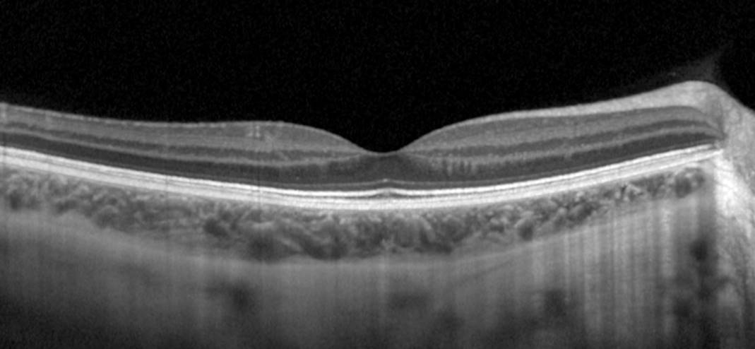 yeni-bir-optik-koherens-tomografi-tekni-i-ile-vitreusun-g-r-nt-lemesi